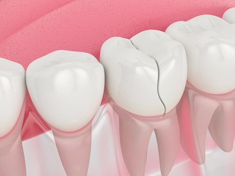 جلوگیری از تسویه‌نشدن پلاک‌ها و کاهش ترک‌های ریز دندانی
